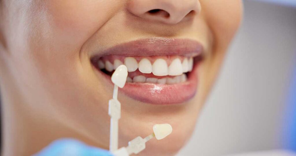 woman with dental veneers
