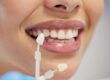 woman with dental veneers