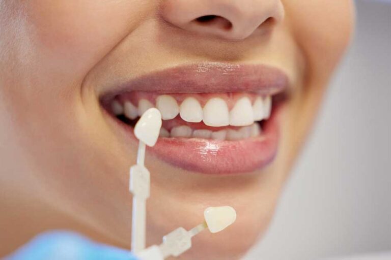 woman with dental veneers