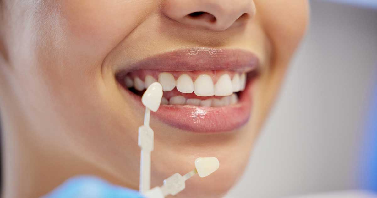 woman with dental veneers