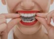 Taking Care of Your Invisalign Trays