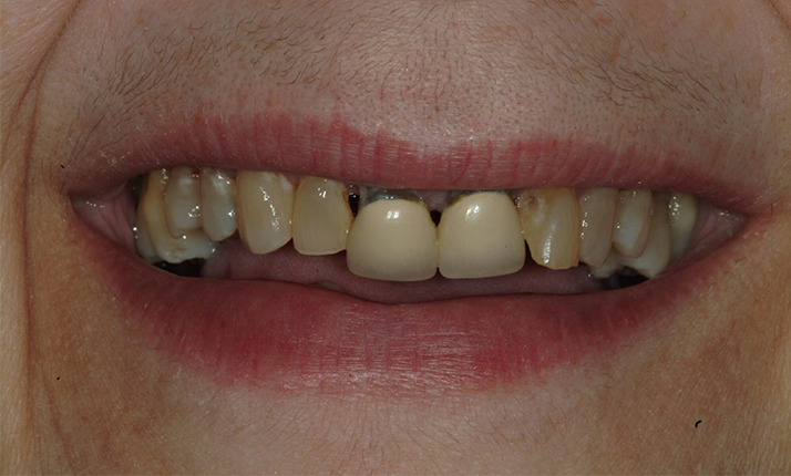 Before