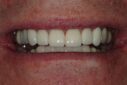 Close-up of clean white teeth after professional dental cleaning.
