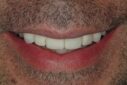 Clean, bright smile after dental treatment with improved tooth color.