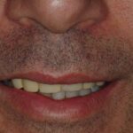 Before dental cleaning with discoloration and buildup.