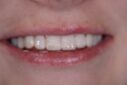 Bright, clean smile with white teeth after dental cleaning