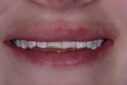 Before dental cleaning with visible plaque and staining.