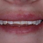 Before dental cleaning with visible plaque and staining.