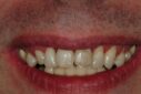 Teeth before dental cleaning with plaque and discoloration.