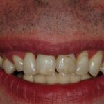 Teeth before dental cleaning with plaque and discoloration.