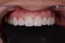 Close-up of healthy white teeth and gums during dental exam.