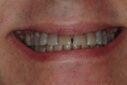 Close-up of teeth with plaque and stains before cleaning.