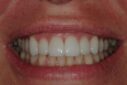 Close-up of bright white teeth in a smiling mouth.